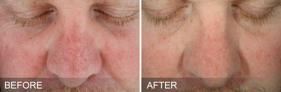 before-after-SunDamage.jpg