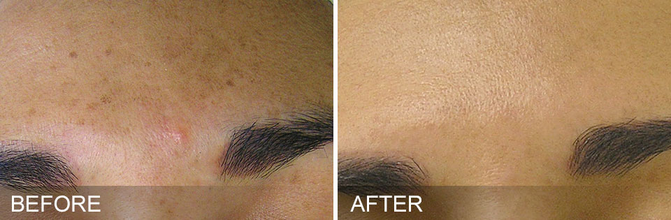 before-after-BrownSpots.jpg